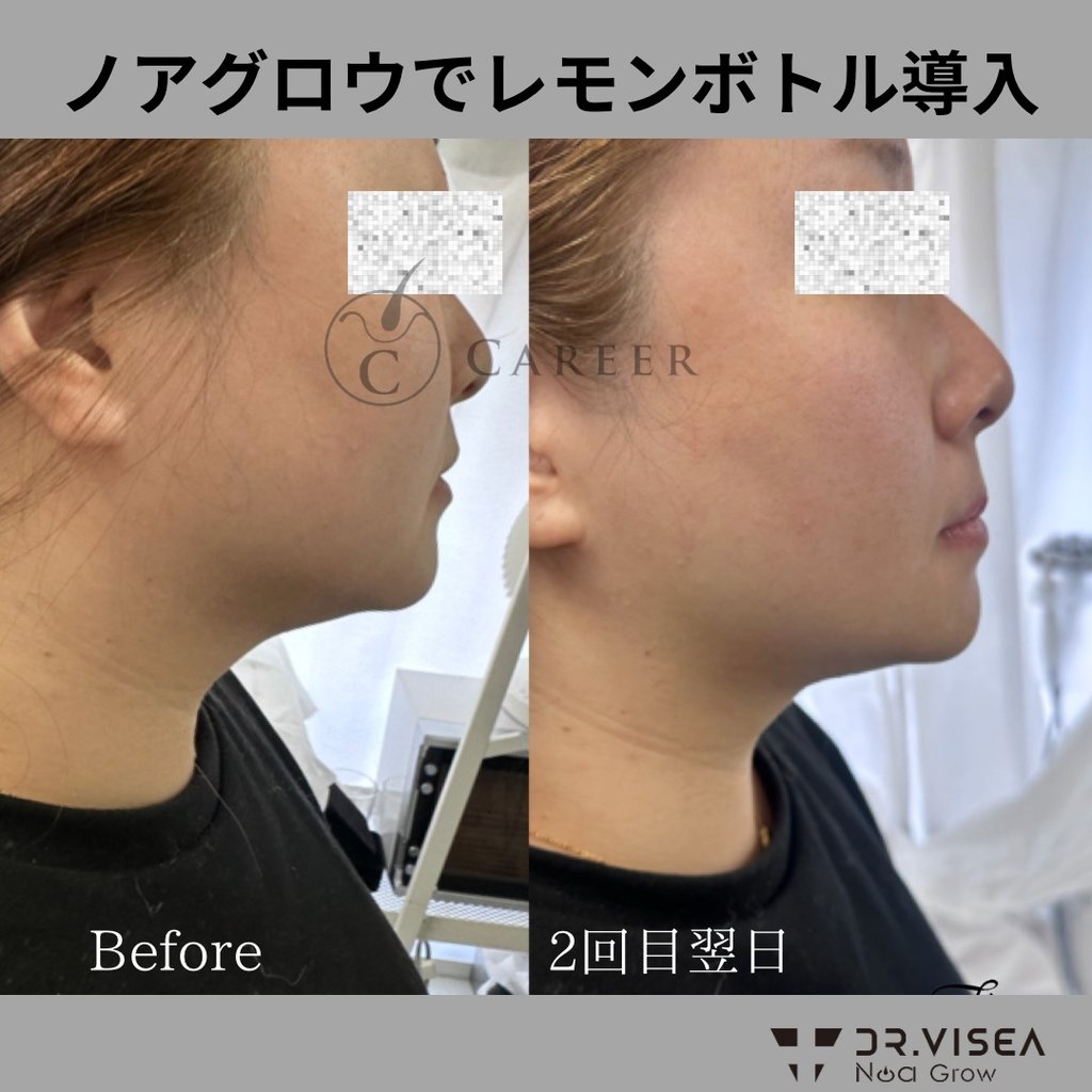 ✨即発送✨ノアグロウ 同型導入美容機器＋25pinチップ×10個 レモンボトル ✨即発送可✨ノアグロウ 同型導入美容機器＋25pinチップ×12個