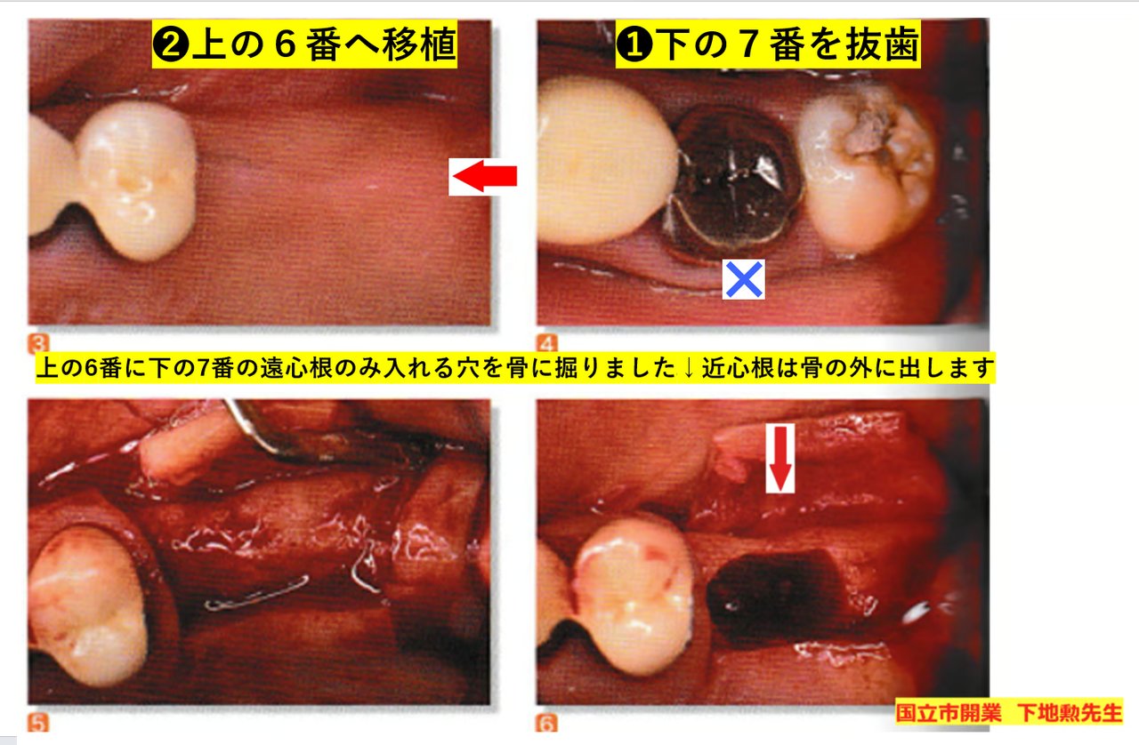 ⑩・歯の移植について | 頭蓋の骨格から直す小児矯正です！
