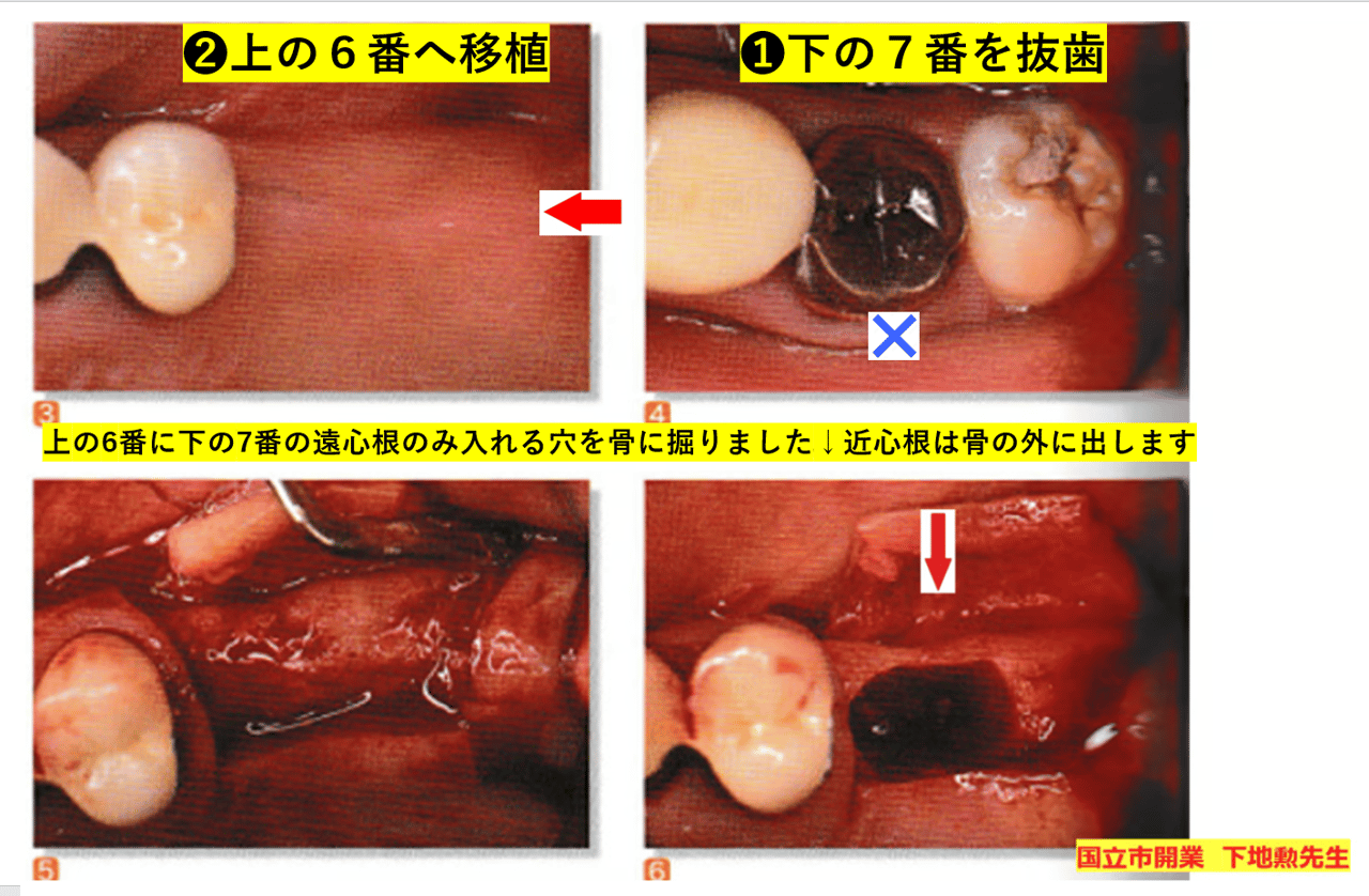 ⑩・歯の移植について | 頭蓋の骨格から直す小児矯正です！