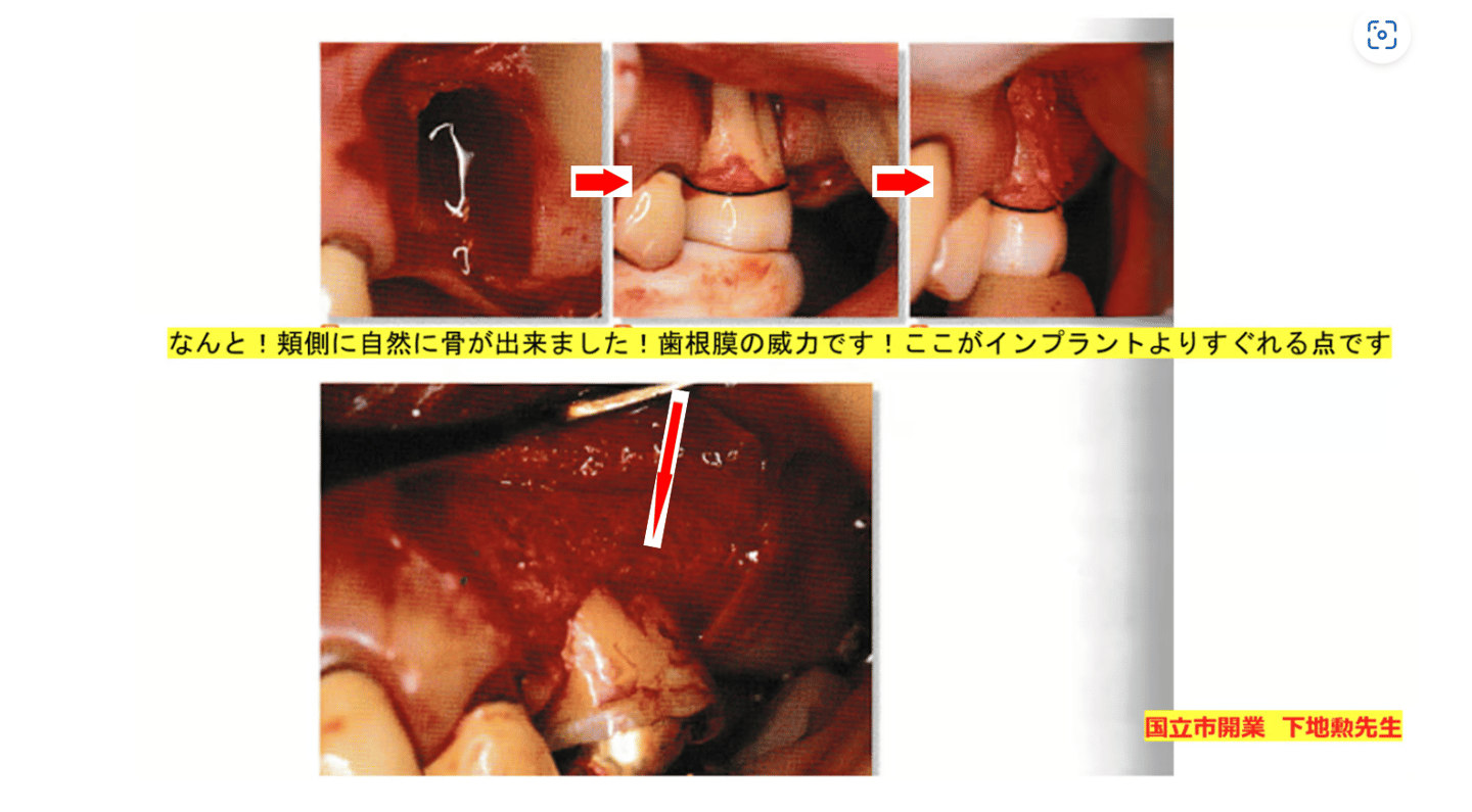 ⑩・歯の移植について | 頭蓋の骨格から直す小児矯正です！