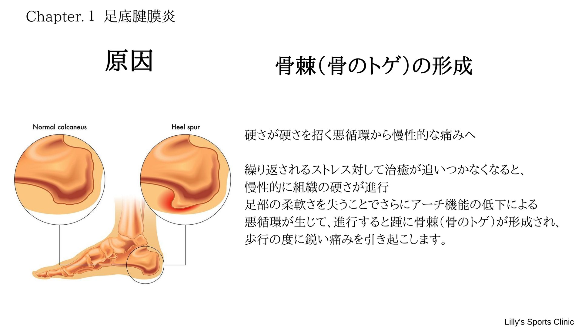足底腱膜炎 - コンテンツ | 五反田スポーツ整形,スポーツ障害
