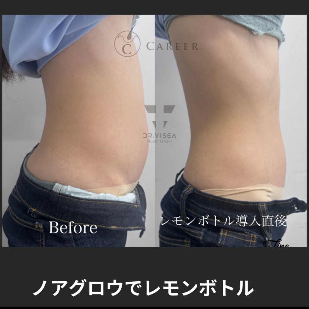 ✨即発送✨ノアグロウ 同型導入美容機器＋25pinチップ×10個 レモンボトル 水月雨 (MOONDROP) ムーンドロップ 夢回 - Golden Ages