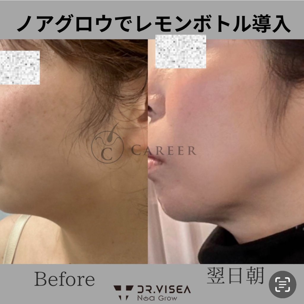 ✨即発送可✨ノアグロウ 同型導入美容機器 ドクタービセア レモンボトル 新品 ノアグロウ | 株式会社Dr.Visea/ドクタービセア